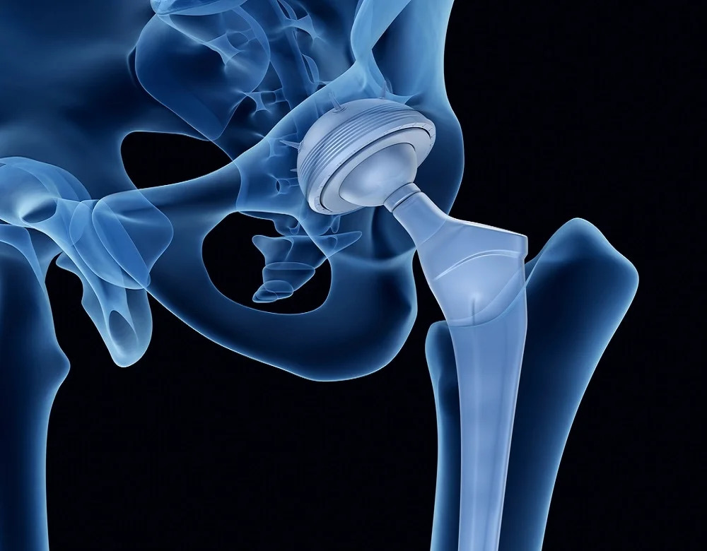Medical Implants - An Overview